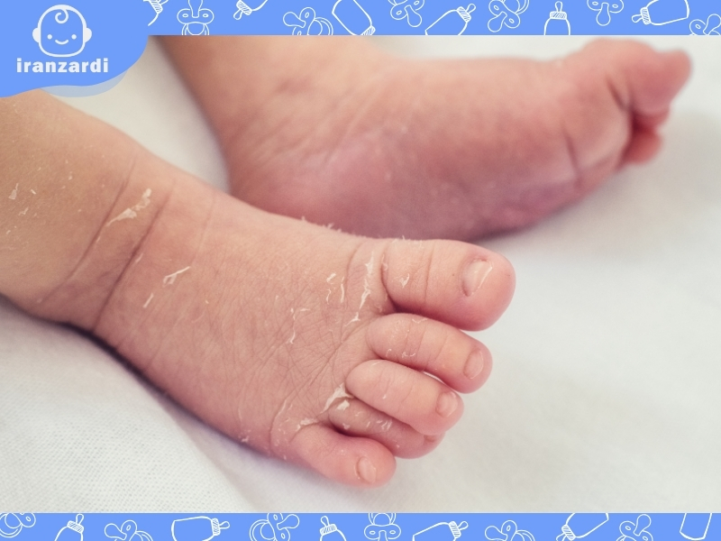 درمان خشکی پوست نوزاد با روش‌های ساده و موثر