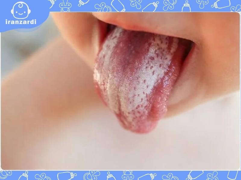 برفک دهان نوزاد چیست؟ تشخیص و درمان برفک دهان نوزاد