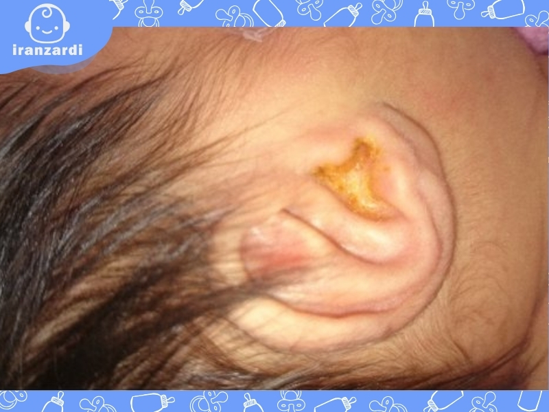 علت ترشح  چرک زرد گوش نوزاد چیست؟ علل+پیشگیری+درمان