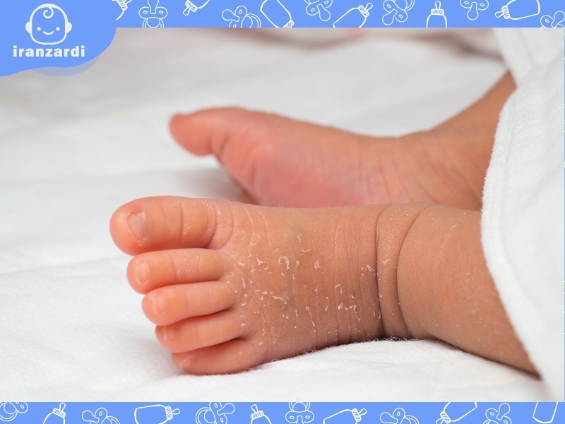 پوست ریزی نوزاد نشانه چیست و چگونه درمان می­‌شود؟