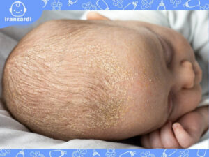 علت پوست ریزی سر نوزاد