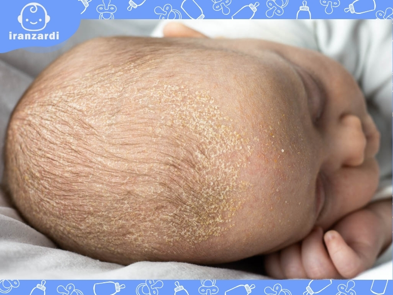 علت پوست ریزی سر نوزاد چیست؟ درمان پوسته شدن سر نوزادان