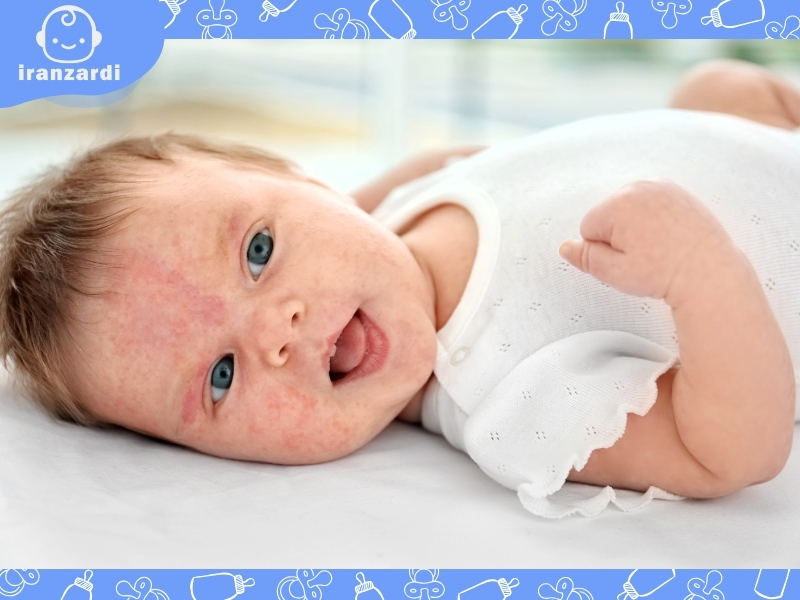 انواع اگزما در نوزاد را چطور درمان کنیم؟ درمان خانگی اگزما در کودکان و نوزادان