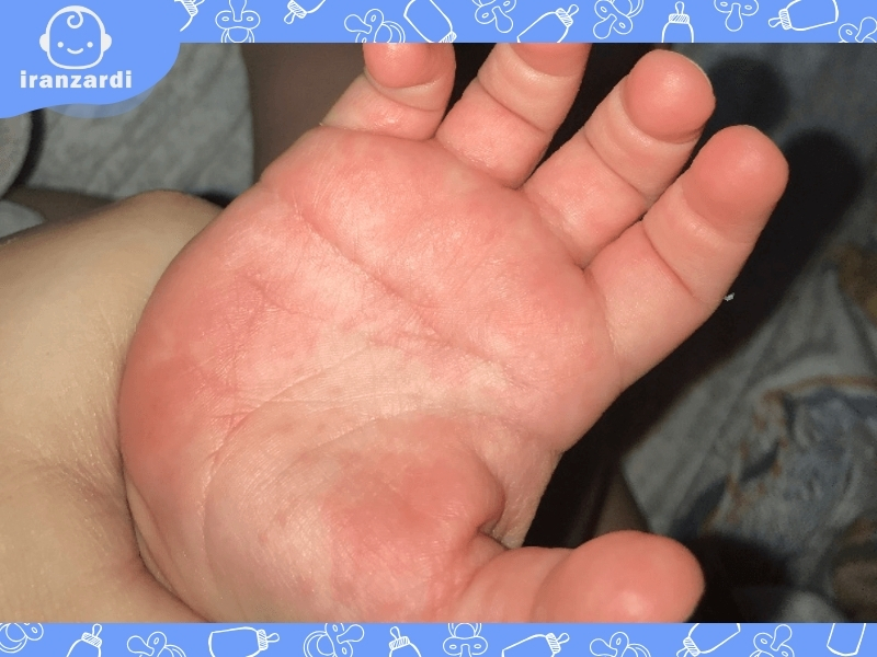 اگزمای دیسیدروتیک (dyshidrotic eczema)