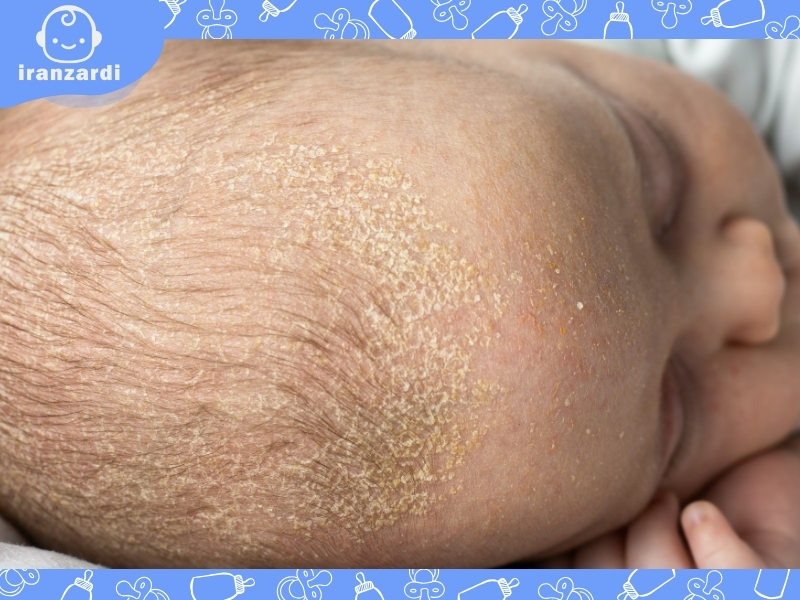 درماتیت سبورئیک (seborrheic dermatitis)