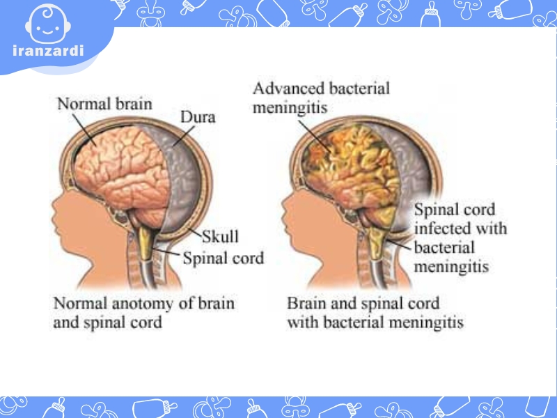 مننژیت کودکان چگونه تشخیص داده می‌شود؟