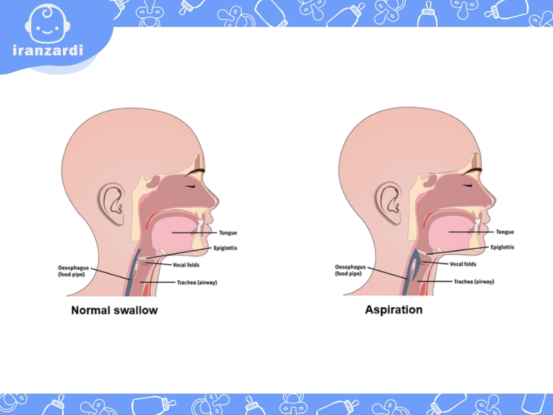 علت اختلال بلع کودکان